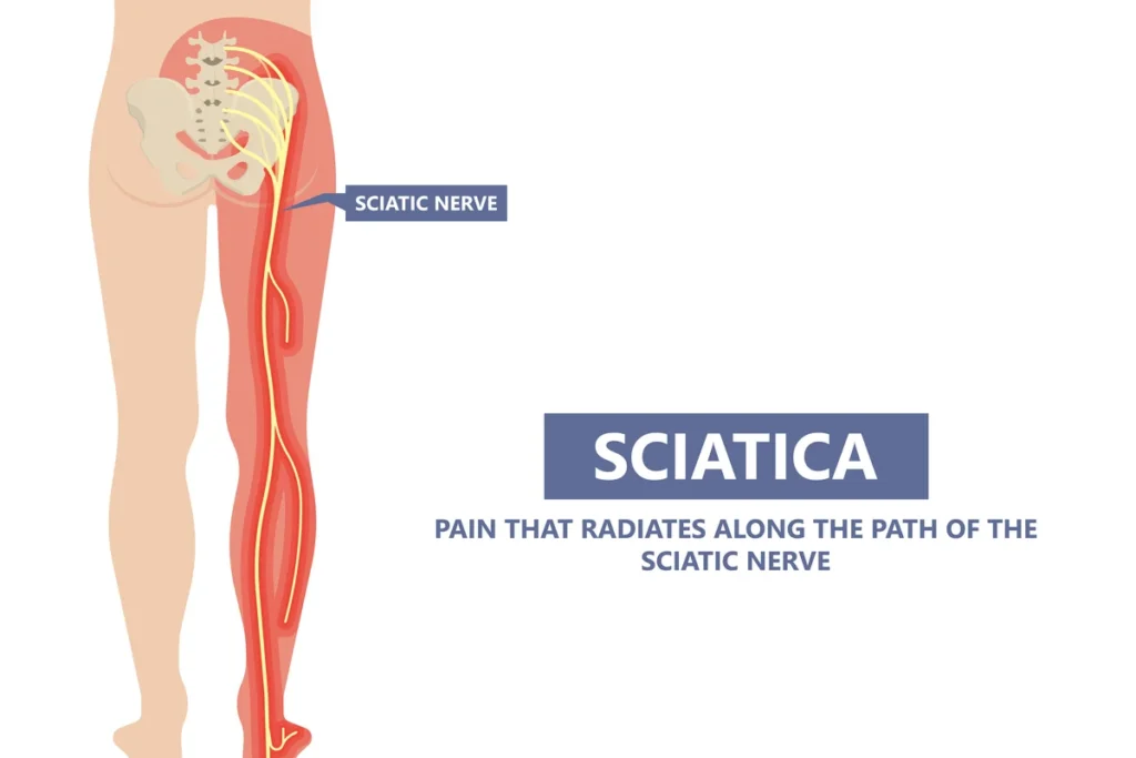 Sciatica, Piriformis syndrome and Relaxin during pregnancy
