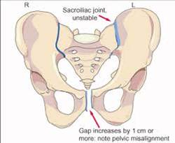 Unstable joints in the pelvis shown that is caused by Sciatica, Piriformis syndrome and relaxin during pregnancy